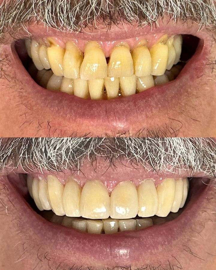 Sorriso de paciente antes e depois do tratamento periodontal