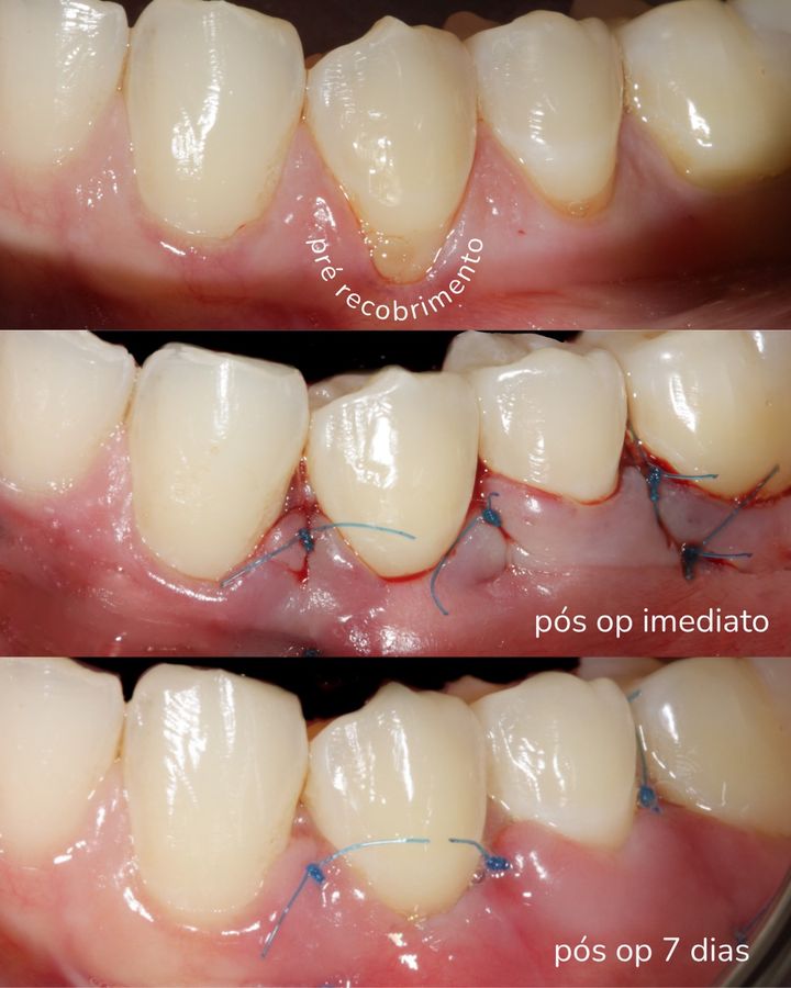 Recobrimento radicular antes da cirurgia, no pós-operatório imediato e com 7 dias