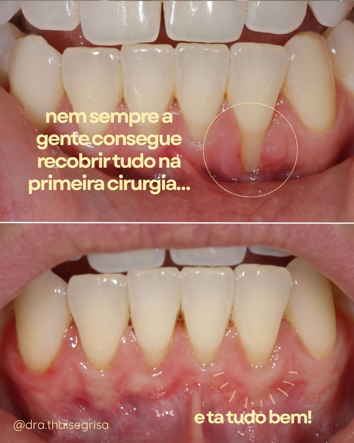 Antes e depois de recobrimento radicular em dente inferior