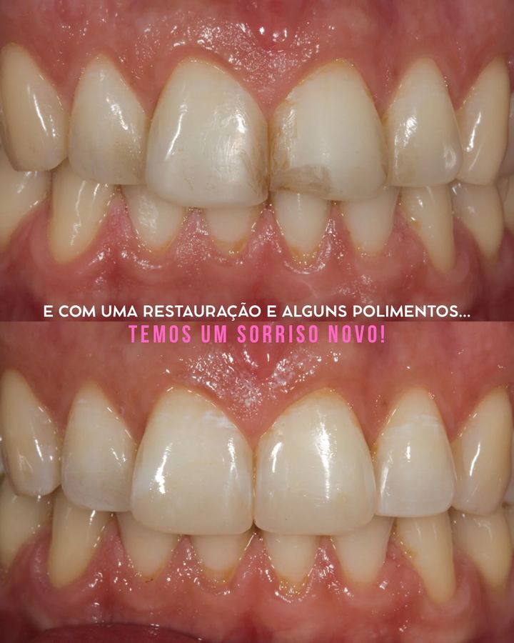 Dentes da frente antes e depois de uma restauração e polimentos